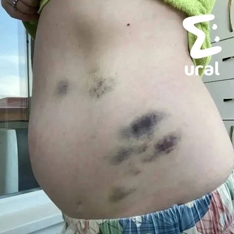 Иностранцы ЗАЩИПАЛИ екатеринбурженку возле кафе "Дияр" на Готвальда, рассказала сама пострадавшая Иностранцы ЗАЩИПАЛИ екатеринбурженку возле кафе "Дияр" на Готвальда, рассказала сама пострадавшая