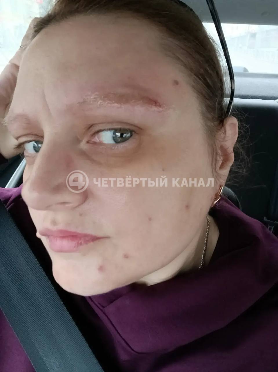 Из-за сожжённых бровей екатеринбурженка обратится в Верховный суд РФ