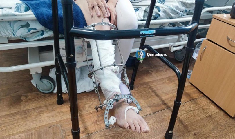 Врачи Алапаевска пришили женщине почти оторванную мотоблоком ступню